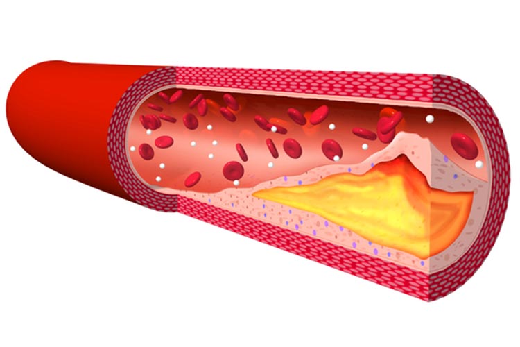 脂質異常症画像